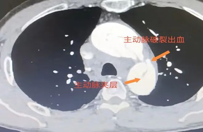 undefined 59 分钟!我院心脏大血管外科团队联手多学科跑赢「夹层风暴」