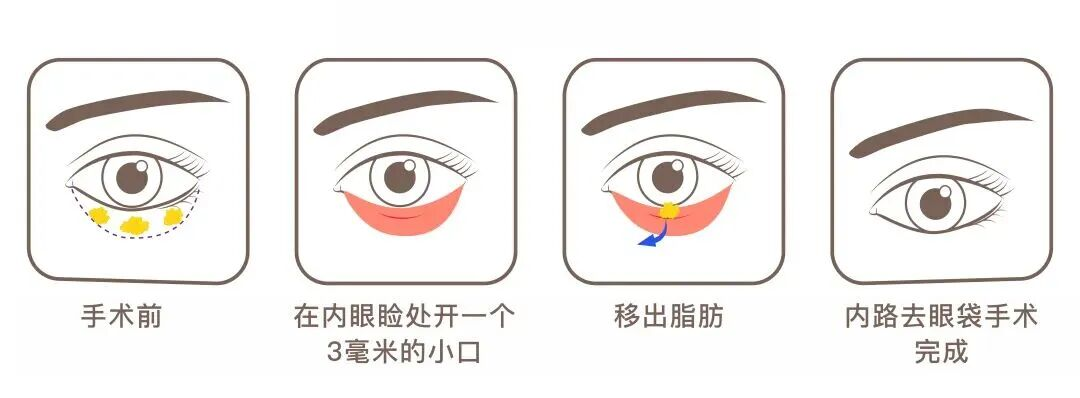 【医路有知】告别眼袋,科学认识「疲惫眼」