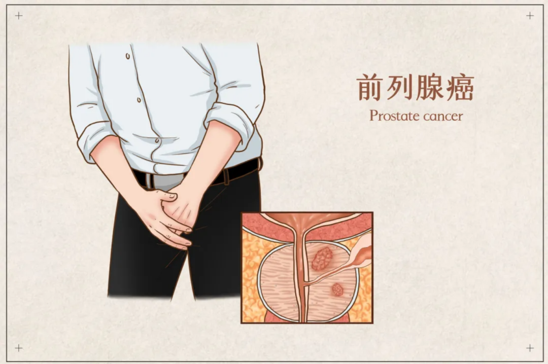 不疼不痒却查出前列腺癌?多亏了这项「金标准」检查