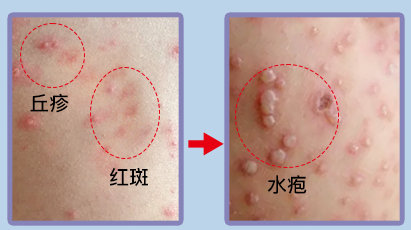 科学预防，健康同行——夏季常见传染病预防知识宣传