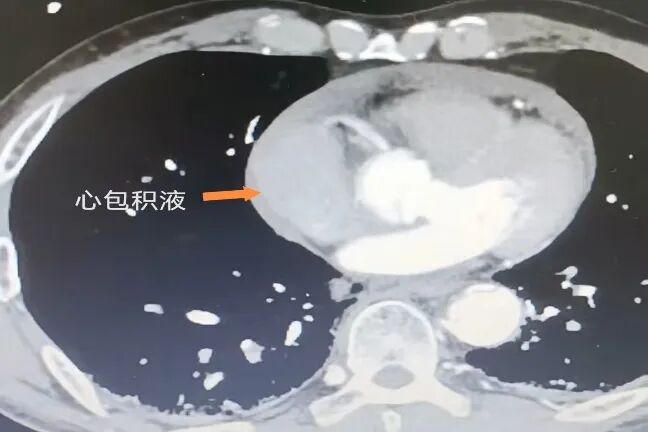 undefined 59 分钟!我院心脏大血管外科团队联手多学科跑赢「夹层风暴」