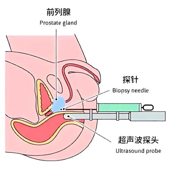 不疼不痒却查出前列腺癌?多亏了这项「金标准」检查