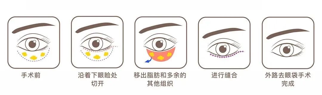 【医路有知】告别眼袋,科学认识「疲惫眼」