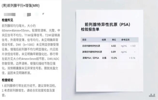 不疼不痒却查出前列腺癌?多亏了这项「金标准」检查
