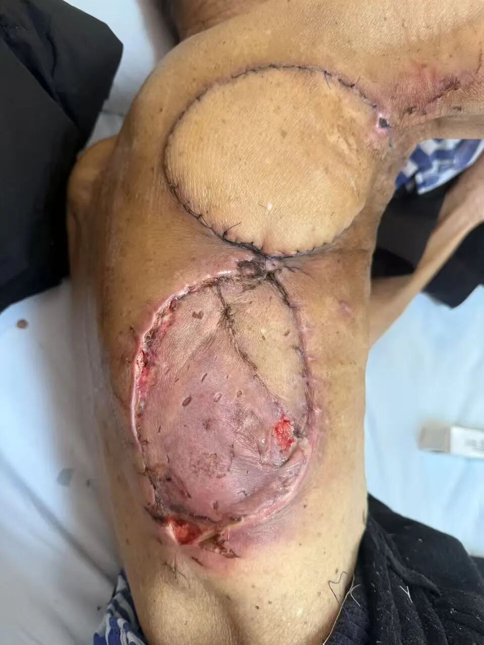 病例会说话｜八旬老人皮肤癌变破溃、屡次复发，这次终于彻底治愈