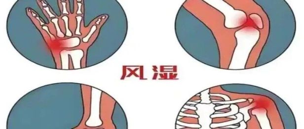 【二附院医生说】以为只是关节痛？小心，你的免疫系统可能在「攻击」自己！