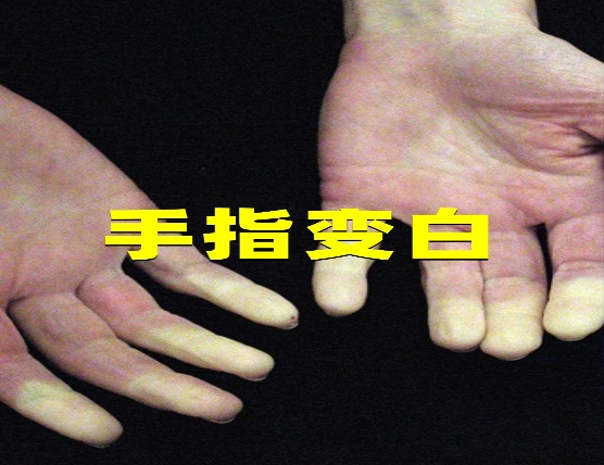【二附院医生说】以为只是关节痛？小心，你的免疫系统可能在「攻击」自己！