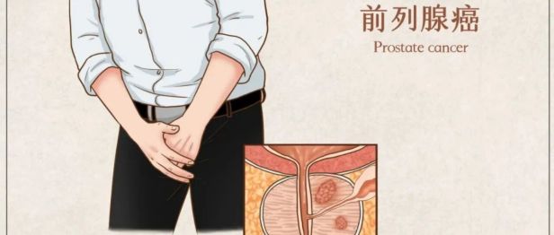不疼不痒却查出前列腺癌？多亏了这项「金标准」检查