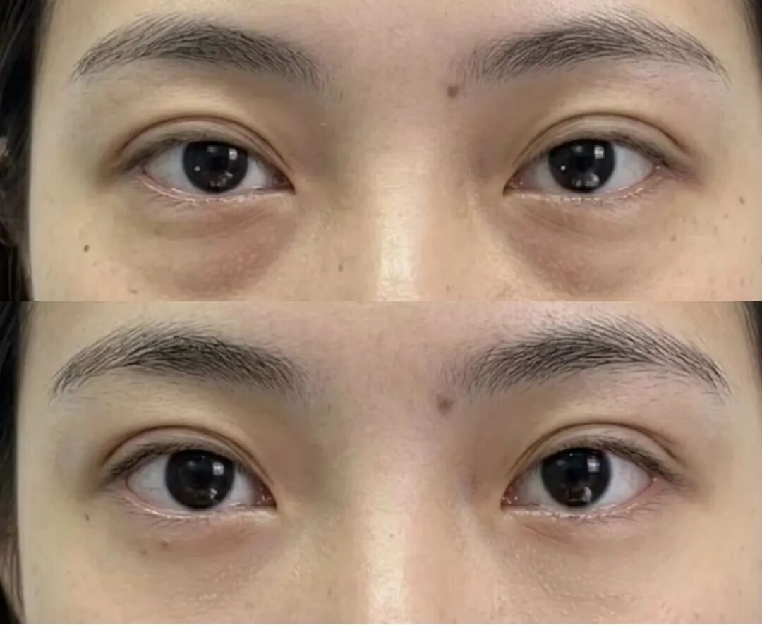 【医路有知】告别眼袋,科学认识「疲惫眼」