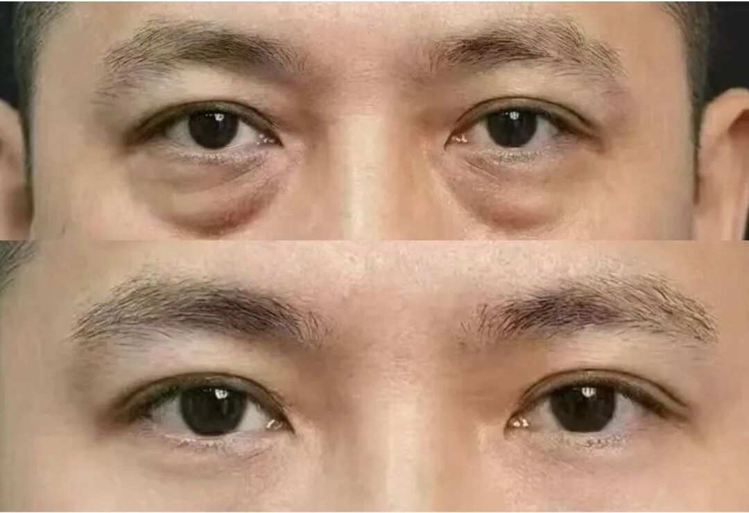 【医路有知】告别眼袋,科学认识「疲惫眼」