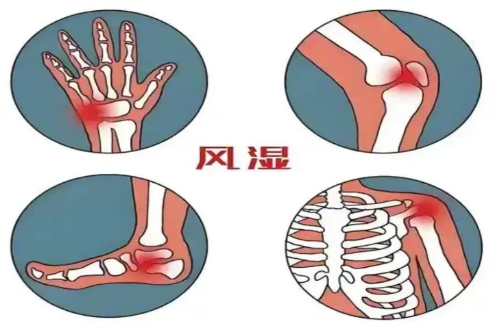 【二附院医生说】以为只是关节痛？小心，你的免疫系统可能在「攻击」自己！
