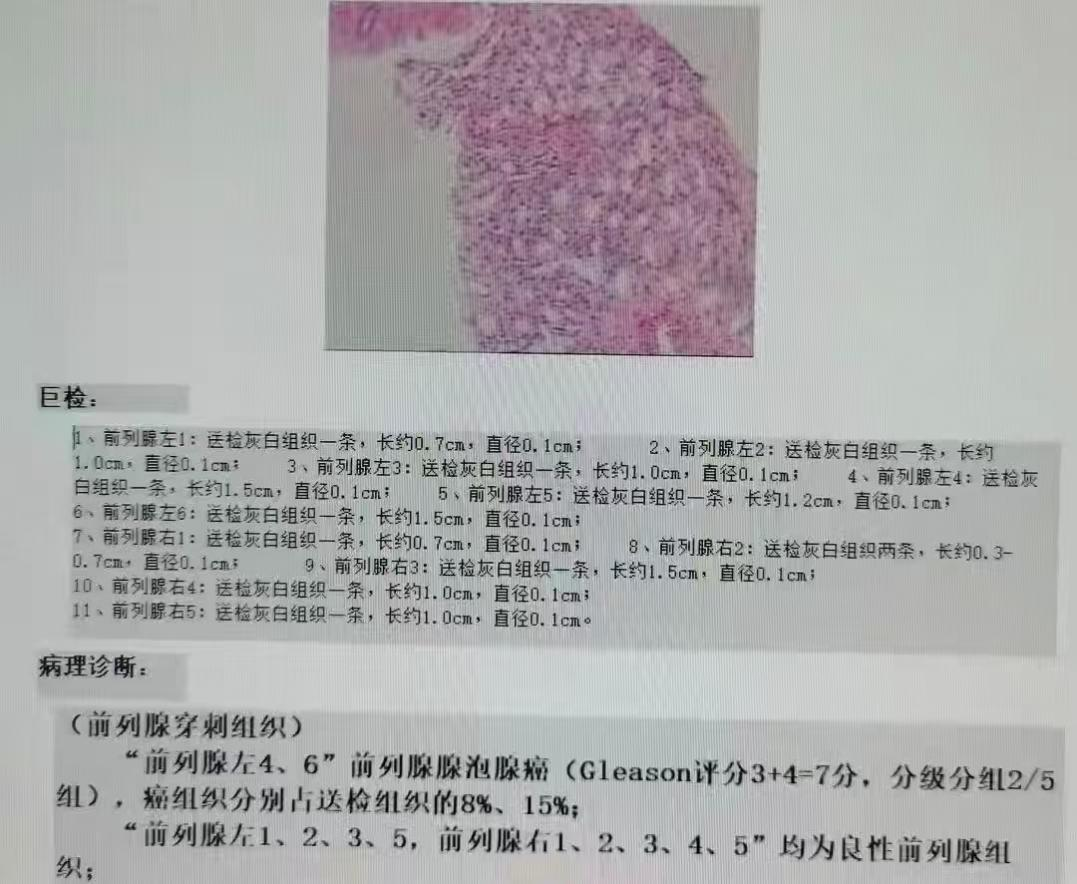 不疼不痒却查出前列腺癌?多亏了这项「金标准」检查