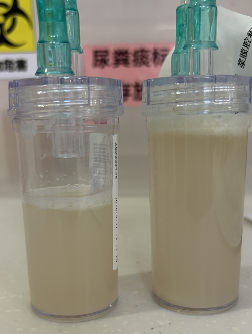 35 岁,病程 30 年,终于有了眉目——我院呼吸内科精准诊疗 罕见原发性纤毛不动综合征