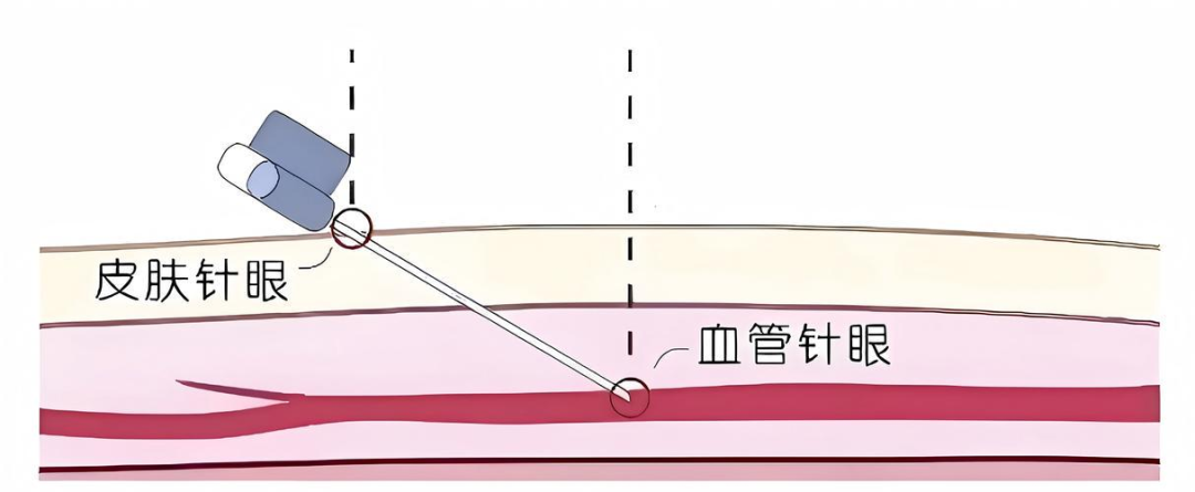 输液后淤青别慌!--这份「黄金按压法」请收好