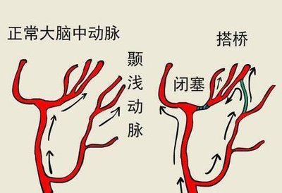 【人医科普】频繁头晕别当是累!这种极易误诊的脑血管病偏爱中青年