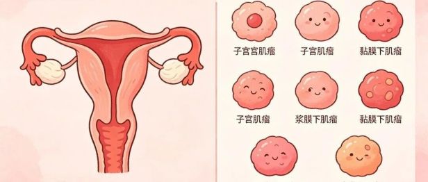 不开刀，也能消灭子宫肌瘤？！