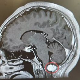 头晕走路不稳，不是颈椎病？真相让她崩溃了