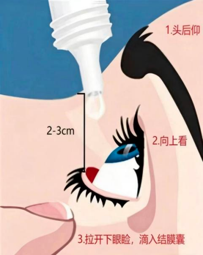 很多人都不会滴眼药,可能一开始就选错了......