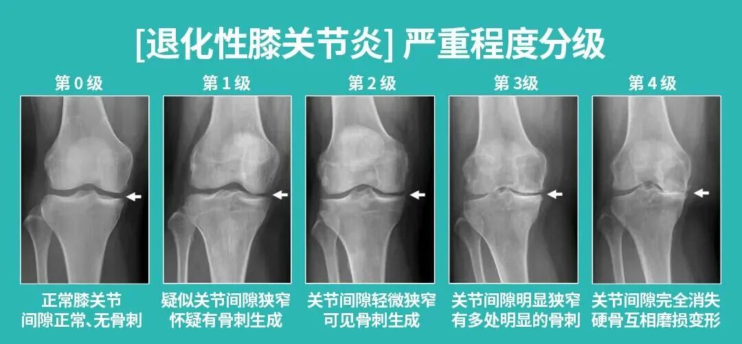 膝盖痛别硬扛!76 岁老人重度膝内翻畸形,骨科专家为其「换膝」解除病痛