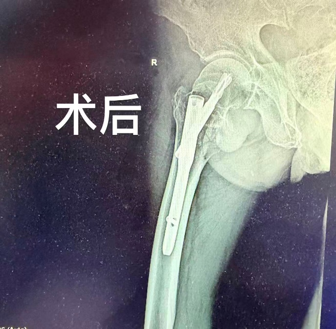 冠脉堵塞 95% 又骨折!73 岁老人手术难题这样破
