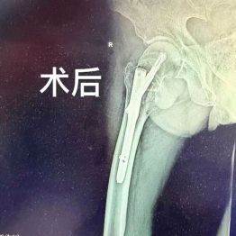 冠脉堵塞 95% 又骨折！73 岁老人手术难题这样破