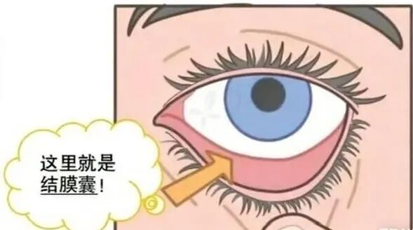 很多人都不会滴眼药,可能一开始就选错了......