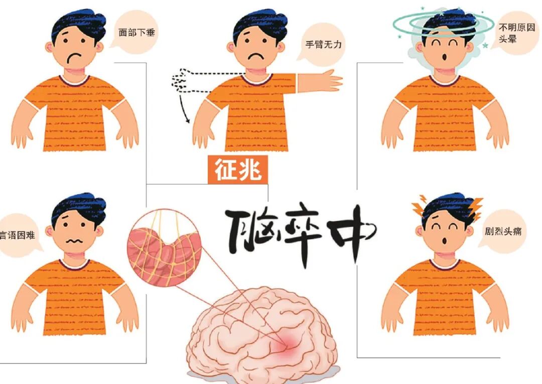 年轻人,别被中风「偷袭」