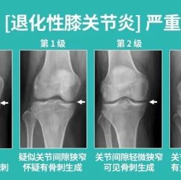 膝盖痛别硬扛！76 岁老人重度膝内翻畸形，骨科专家为其「换膝」解除病痛