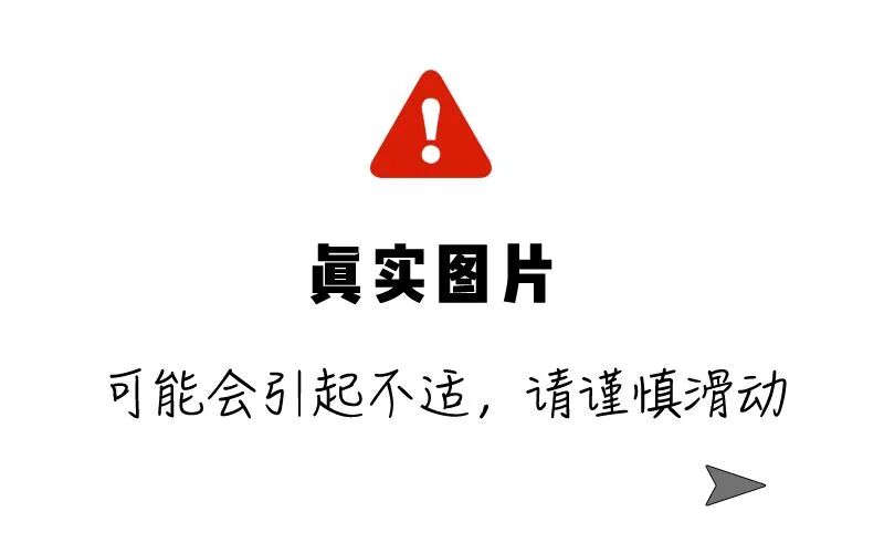 36 岁男子半夜反复晕倒，竟查出「老年脑」！医生：问题出在……