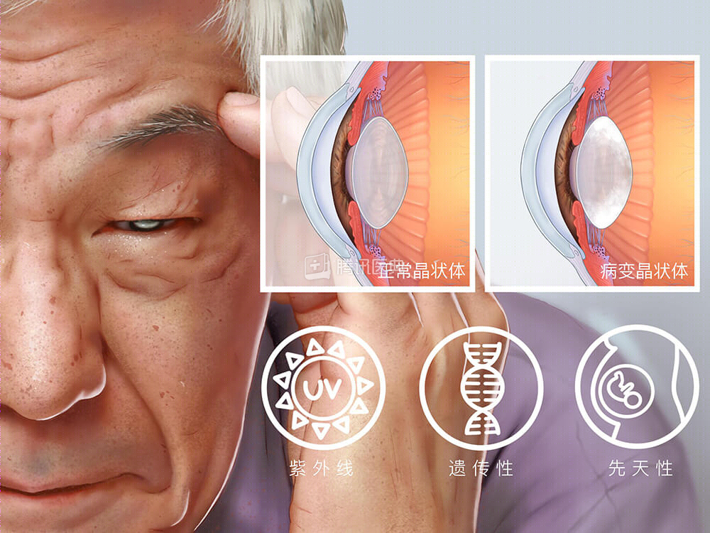 全球首位的致盲性眼病，视物模糊、发暗的人要警惕了