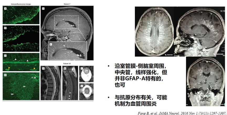 视力下降、腿脚无力?警惕大脑「发炎」的新型罕见病——自身免疫性 GFAP 星形细胞病