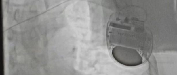 国文医院首例 ICD 植入手术圆满落地！体内「心脏救生舱」筑牢猝死防护墙