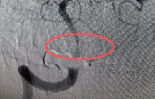 别再把眩晕当「老糊涂」!椎动脉重度狭窄险致脑梗,支架成形术打开生命通道