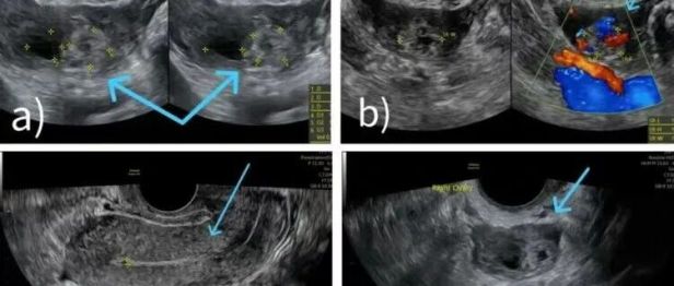 以为痛经却是罕见卵巢妊娠——28 岁女性腹痛入院，腹腔镜微创手术成功保留生育功能