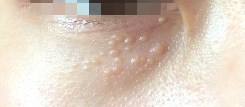 为眼霜申冤!眼周这些小颗粒,到底是什么啊啊啊啊?
