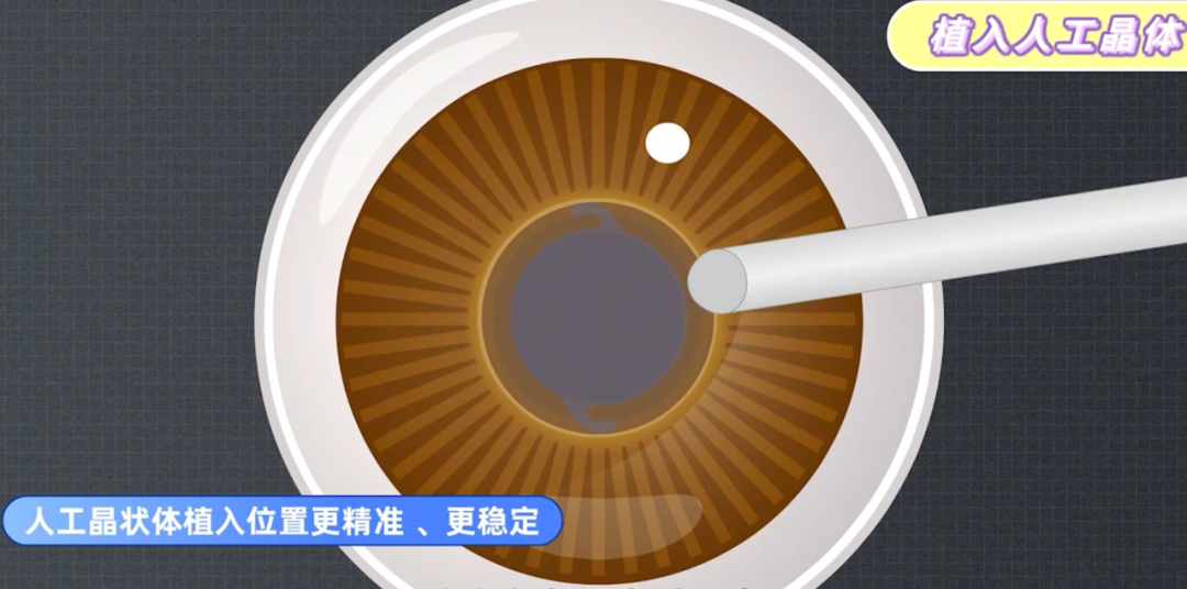 飞秒激光辅助白内障手术,究竟是「智商税」还是「黑科技」?