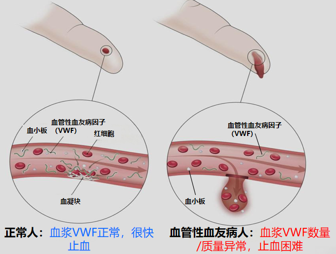 医学破解家族性「出血」谜团——揭秘血管性血友病