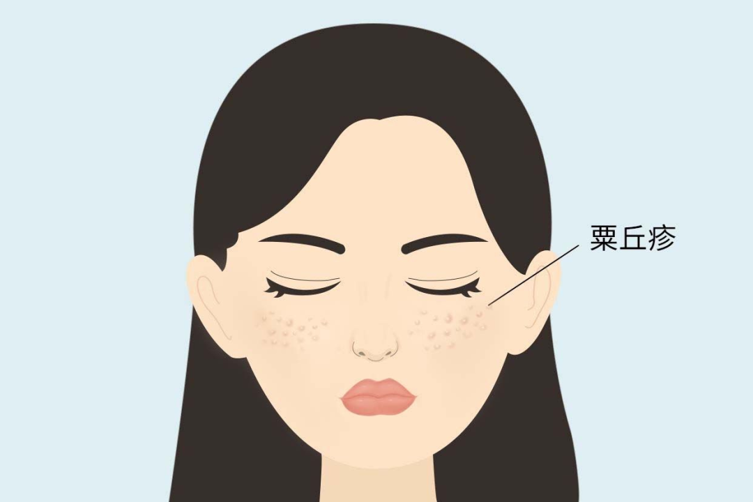 为眼霜申冤!眼周这些小颗粒,到底是什么啊啊啊啊?
