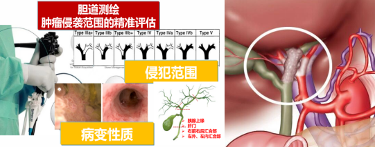 交医精术| 腹腔镜精准切除,外籍胆管癌患者 8 天出院归国