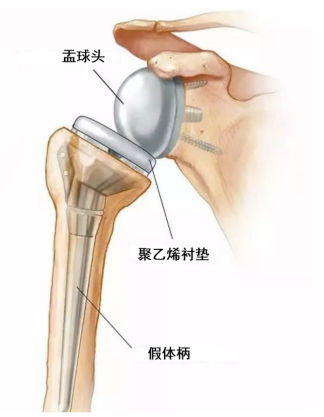 抬手成奢望？肩痛到失眠？反向肩关节置换术助你挣脱「肩」熬