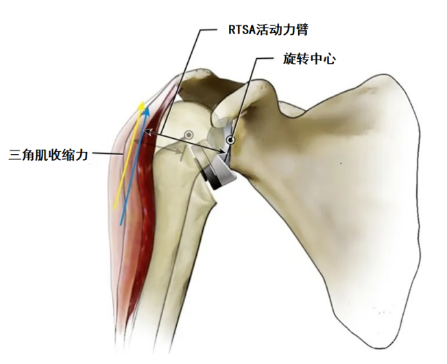 抬手成奢望？肩痛到失眠？反向肩关节置换术助你挣脱「肩」熬