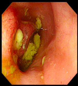 攻坚克难!我院成功救治克罗恩病+免疫性血小板减少紫癜疑难患者