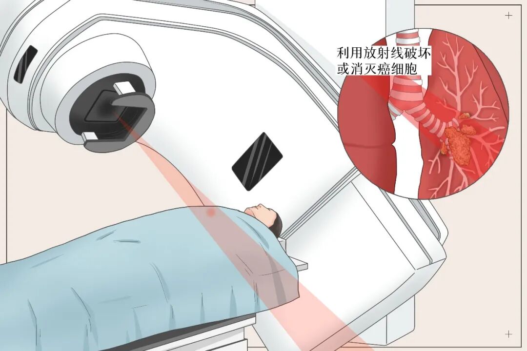 空间晶格放疗：为复杂肿瘤患者带来新的治疗可能