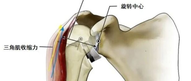 抬手成奢望？肩痛到失眠？反向肩关节置换术助你挣脱「肩」熬