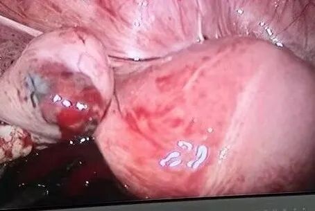 以为痛经却是罕见卵巢妊娠——28 岁女性腹痛入院,腹腔镜微创手术成功保留生育功能