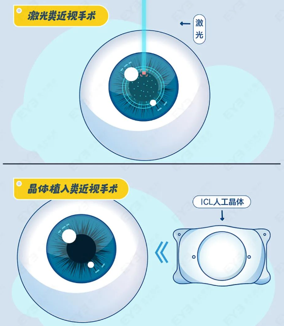 【看过来】近视手术全流程解析!