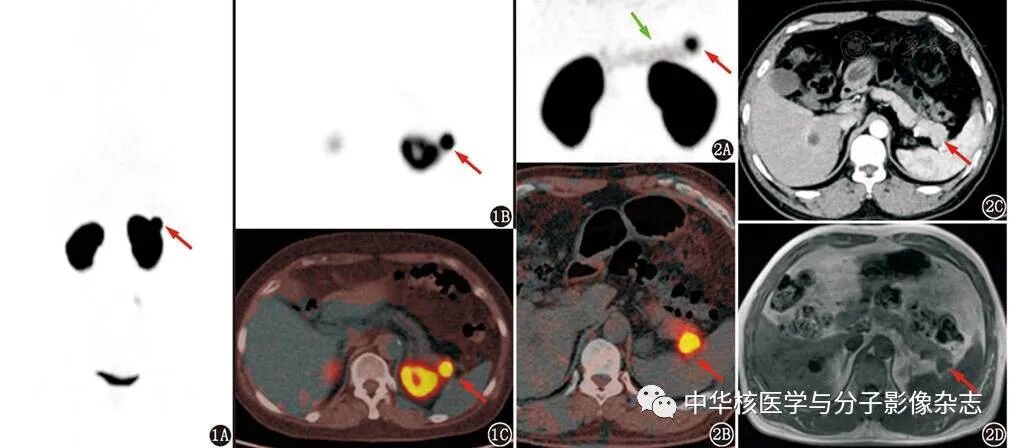 【硬「核」科普】低血糖频繁发作,PET/CT 显像帮忙揪出真相!