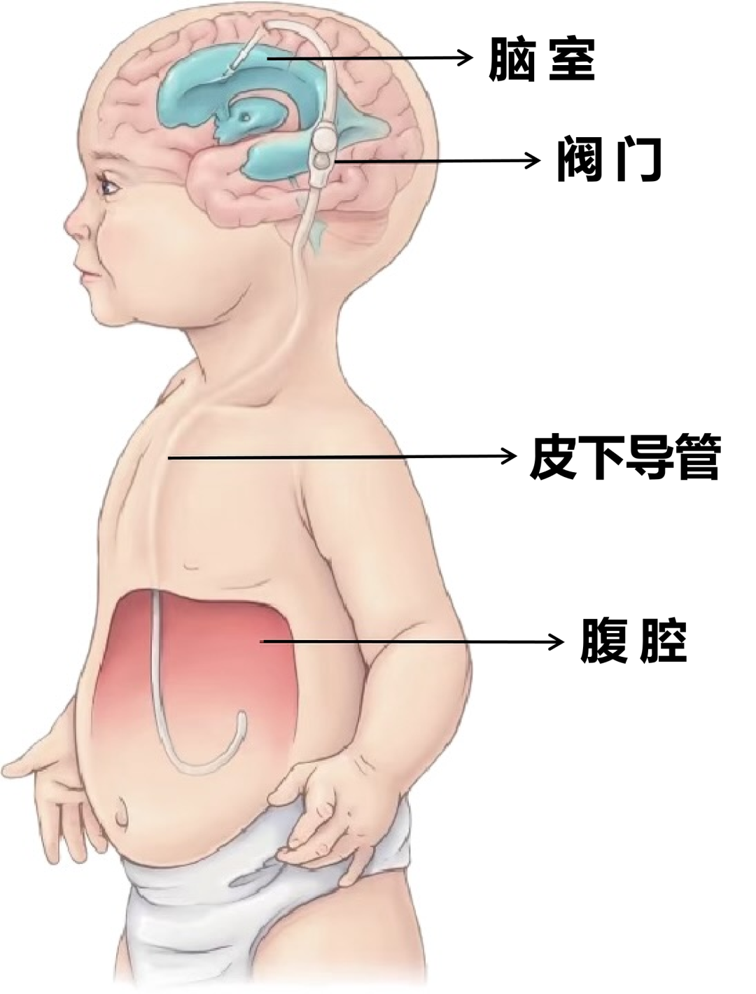 当医生把他脑子里的水,引到了肚子里……
