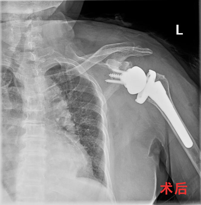 抬手成奢望？肩痛到失眠？反向肩关节置换术助你挣脱「肩」熬