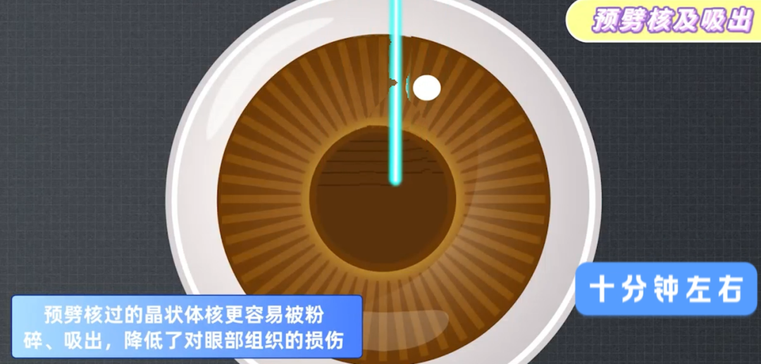 飞秒激光辅助白内障手术,究竟是「智商税」还是「黑科技」?